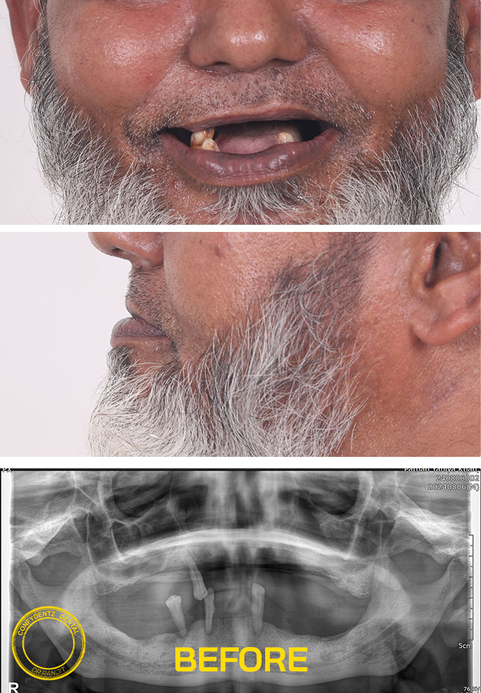 Confydentz Tilted Implants ; All on X case reports