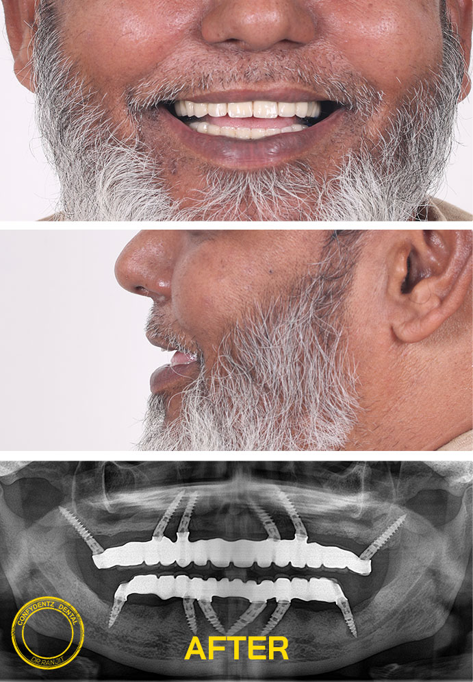 Confydentz Tilted Implants ; All on X case reports