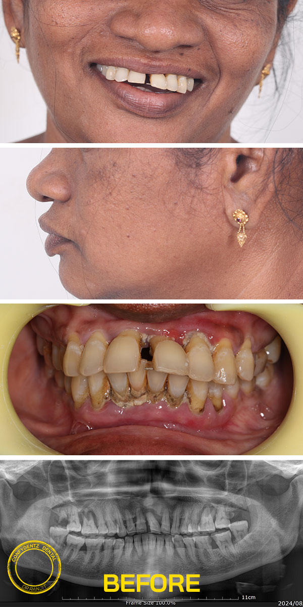 Confydentz Tilted Implants ; All on X case reports