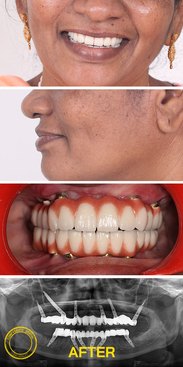 Confydentz Tilted Implants ; All on X case reports