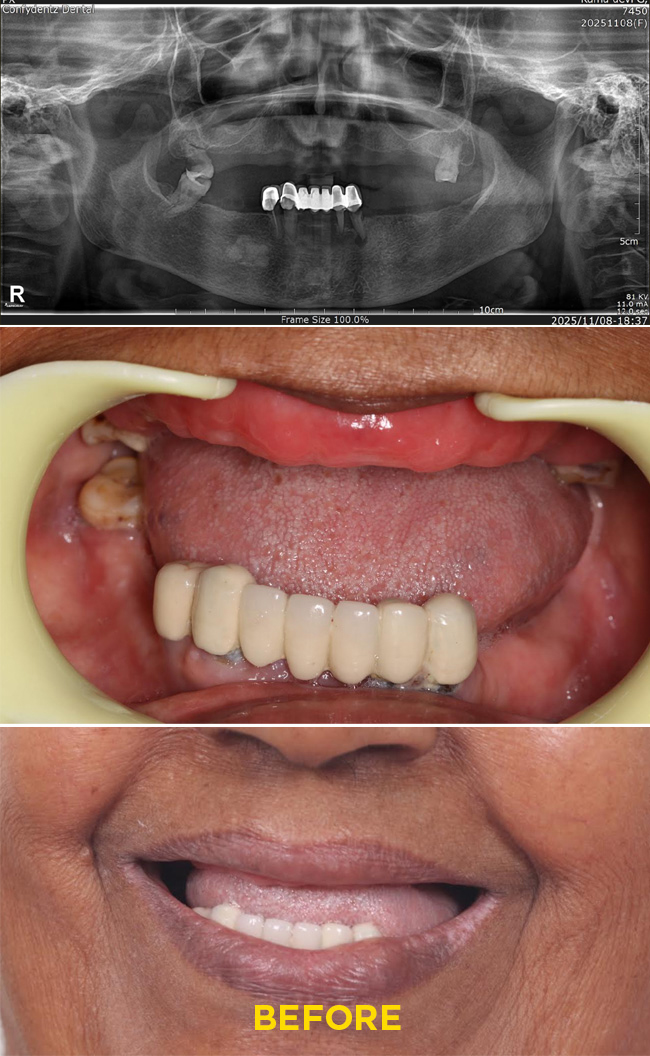 Confydentz Tilted Implants ; All on X case reports