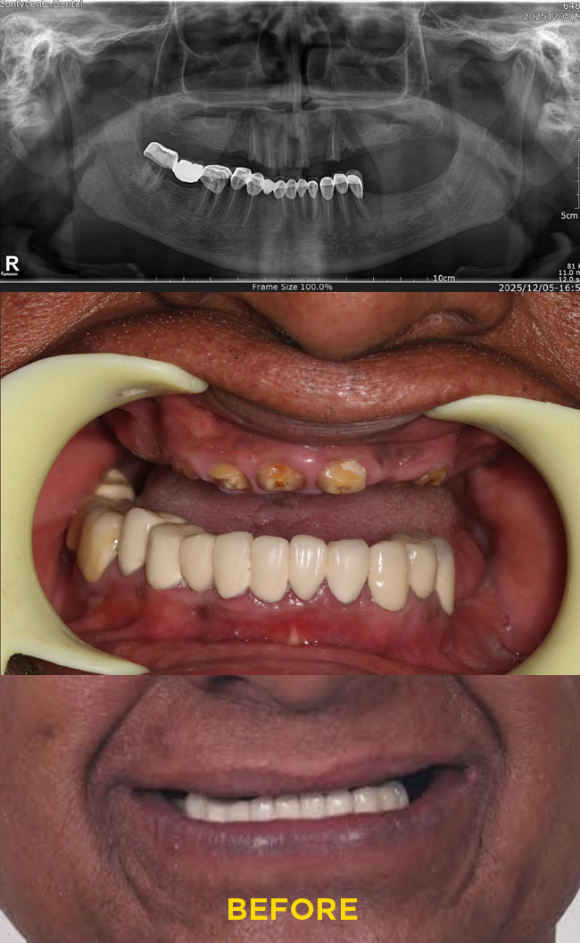 Confydentz Tilted Implants ; All on X case reports