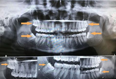 Wisdom Teeth treatment in Guntur